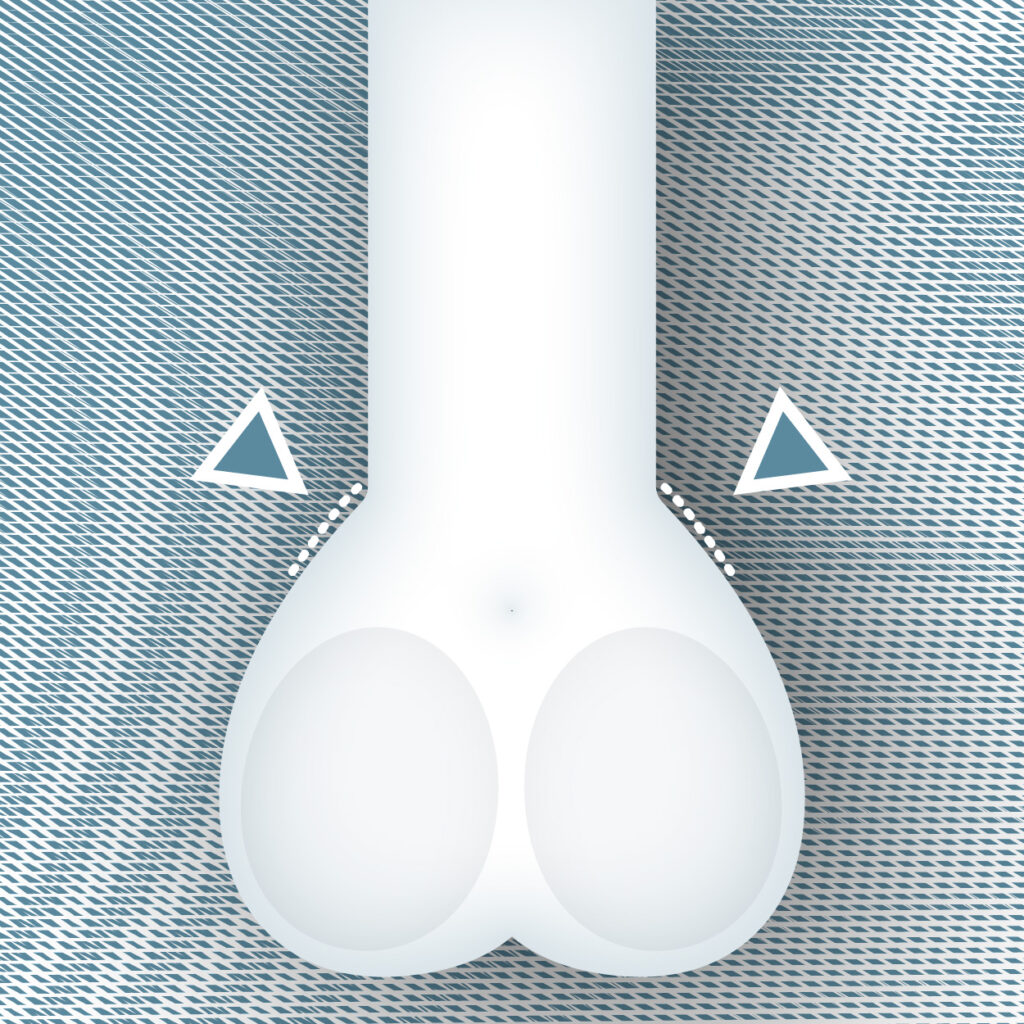 1A- hanse-aesthetic_Hoden_schnittführung-02_125